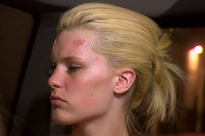 America's Next Top Model Most Iconic Moments - Flesh-eating bacteria