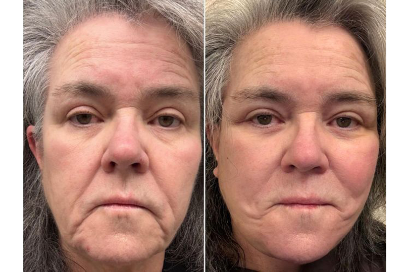 Rosie O'Donnell Is Opening Up About Getting A Deep-Plane Face-Lift